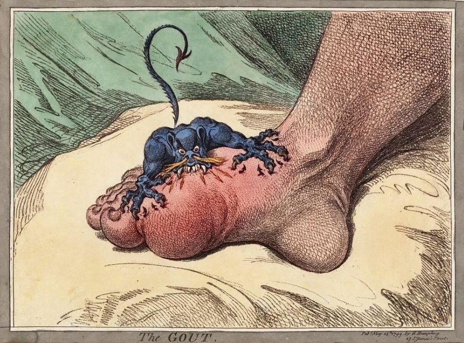 Gillray, The gout, 1799